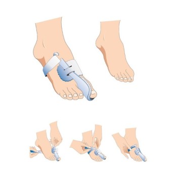 ALLUCE VALGO NOTTURNO PAIA 1